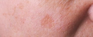 Manchas de pele